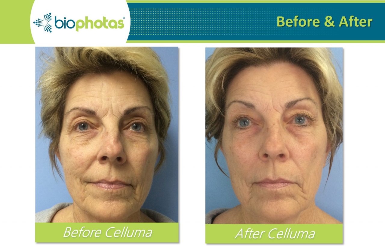 Before & After Wichita's Premiere Cryo Clinic